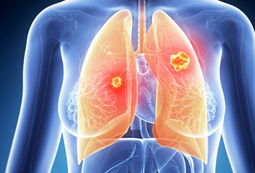 <b>肺癌：是一种被“气”出来的癌</b>