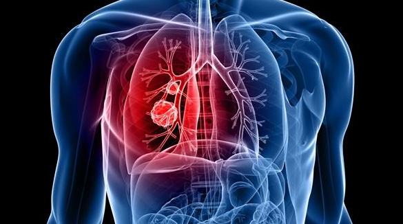 肺癌EGFR靶点突变阳性患者能用