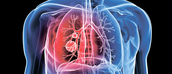 晚期患者进行肺癌治疗选择肺癌