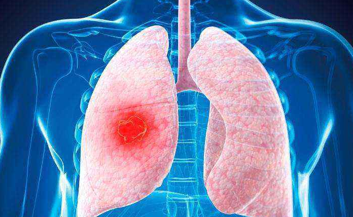 肺,癌的,早期,症状,有,哪些,肿瘤,转移,后,