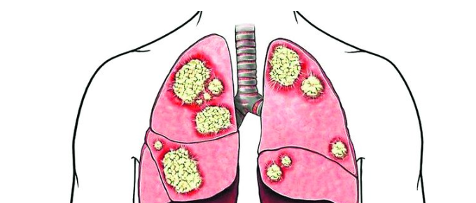 肺癌晚期能活多久？非小细胞肺