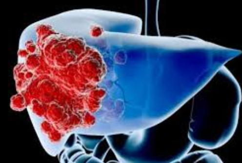 治疗肝癌的靶向药物有哪些？效
