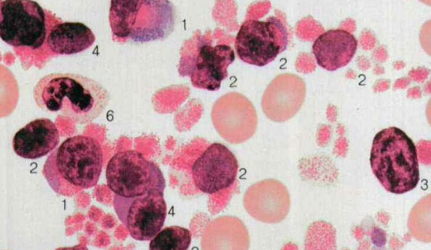<b>什么是急性髓细胞白血病？白细</b>