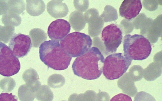<b>维奈托克在急性髓细胞白血病中</b>