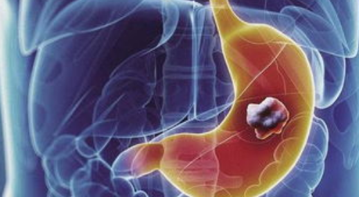 晚期胃癌 胃癌的治疗方法 胃癌能活多久