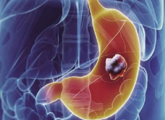 免疫检查 联合治疗 靶向 胃癌 有效治疗