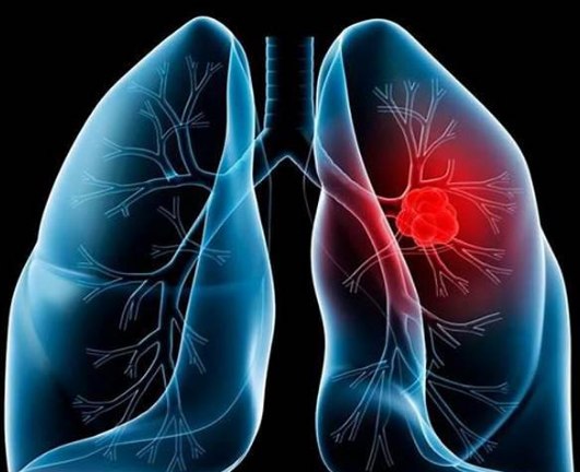 <b>肺癌晚期应该如何治疗？如何预</b>