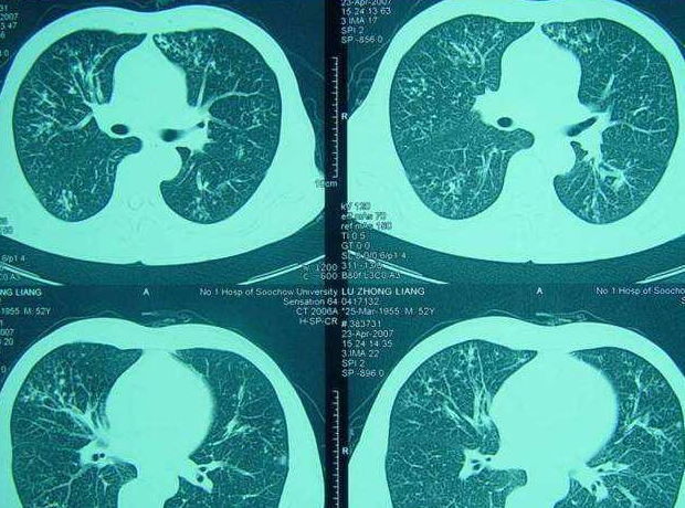 肺癌,转移,是什么,意思,转移性,肺,癌的,症状,