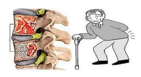 如何正确处理硼替佐米的副作用