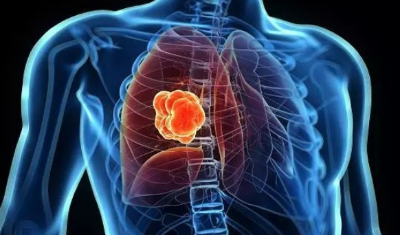 肺癌,早期,的,六大,预兆,是什么,肺癌,是,一种,