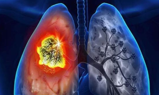 雷莫芦单抗治疗肺癌延长生存期