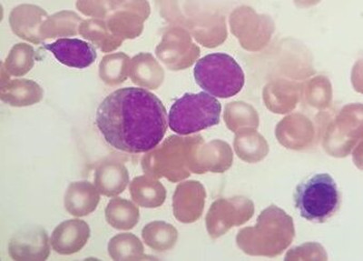 <b>服用泊马度胺应注意什么？</b>