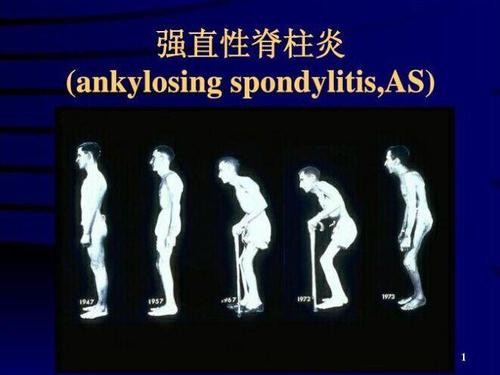 强直性脊柱炎