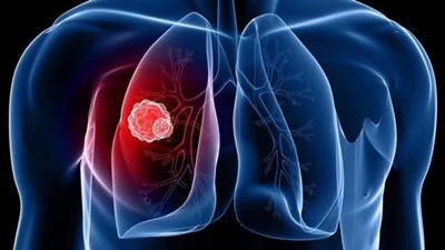 <b>肺癌吃阿来替尼能活多久？</b>