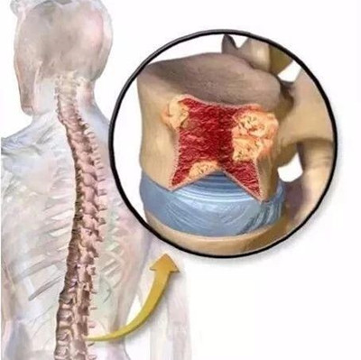 Lenalidomide来那度胺耐药了怎么办？