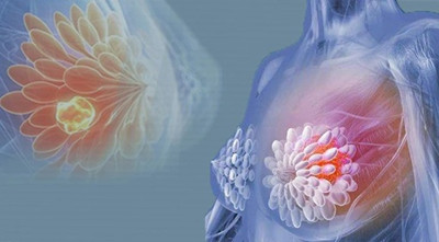 <b>拉帕替尼治疗乳腺癌效果到底怎</b>