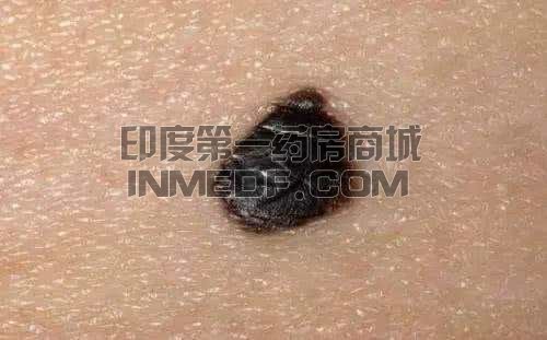 黑色素瘤