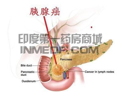 <b>胰腺癌可以用奥拉帕尼治疗吗？</b>