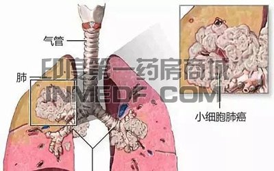 <b>服用吉非替尼出现腹泻怎么办？</b>