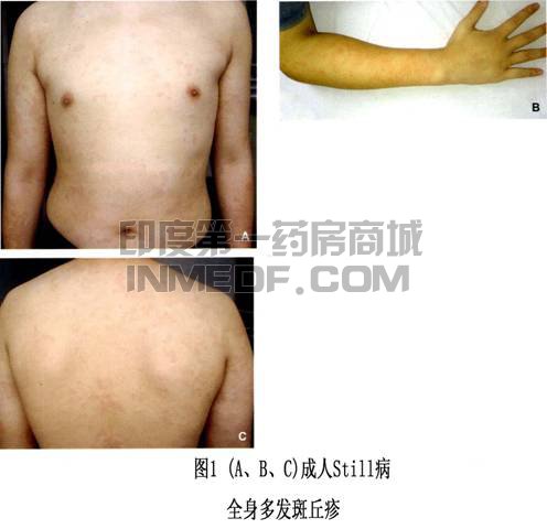 成人斯蒂尔病(AOSD)
