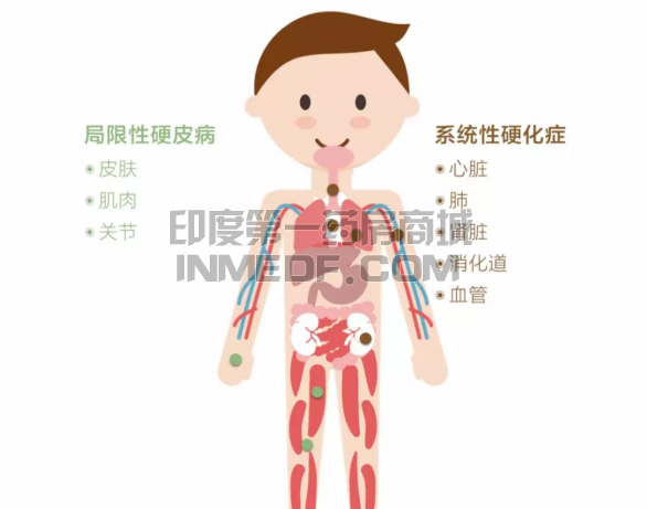 治疗系统性硬化症(SSc)的八款新