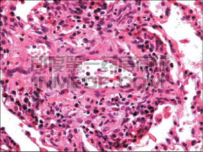 嗜酸性肉芽肿性多血管炎