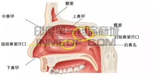 慢性鼻-鼻窦炎伴鼻息肉
