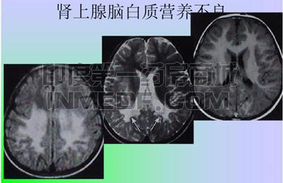 X连锁肾上腺脑白质营养不良