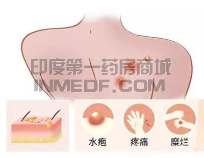 天疱疮