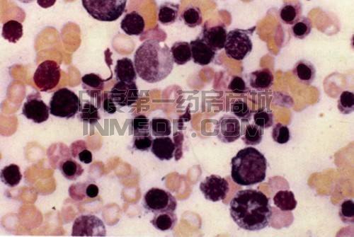 阵发性睡眠性血红蛋白尿