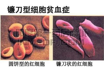 镰刀型细胞贫血病