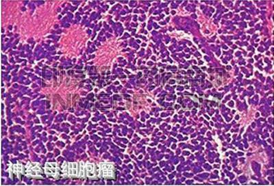 神经母细胞瘤