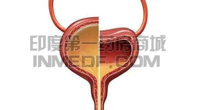 膀胱过度活动症