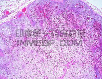 先天性肾上腺皮质增生