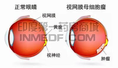 视网膜母细胞瘤