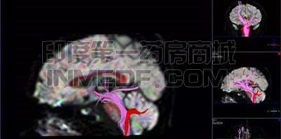 脊髓小脑性共济失调