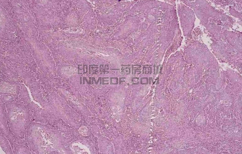 肿瘤标志物，癌抗原（SCC）代表