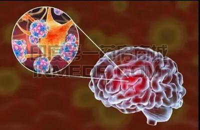 自身免疫性脑炎