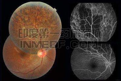 原发性眼内淋巴瘤