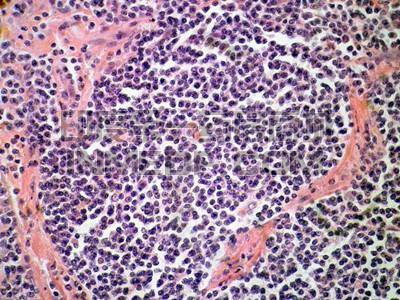 边缘区B细胞淋巴瘤