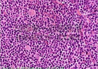 原发性纵隔大B细胞淋巴瘤