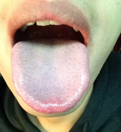 艾滋病感染舌头会是什么样？