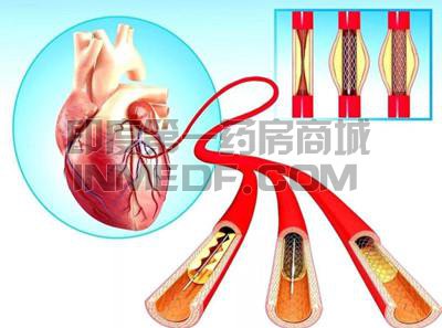 冠状动脉扩张病