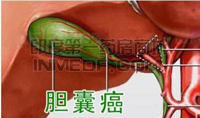 胆囊癌