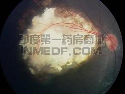 视网膜母细胞瘤