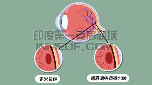 7种治疗糖尿病性黄斑水肿(DME)的药物