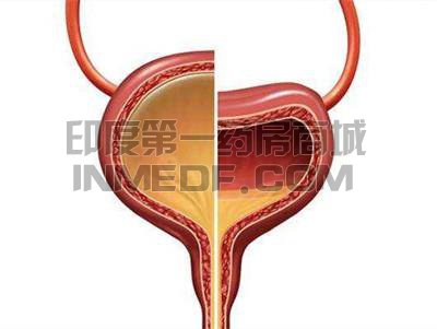 膀胱过度活动症